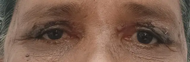 Early postoperative appearance after excision of xanthelasma with a blepharoplasty excision