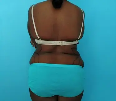 Lipodystrophy of the flanks and hips | Before
