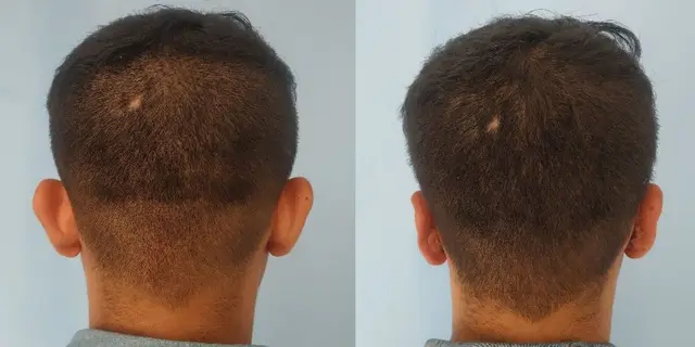 Pushback otoplasty | Posterior  view | Davis and Mustarde procedures