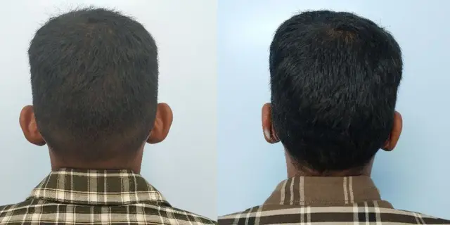 Pushback otoplasty | Posterior  view | Davis and Mustarde procedures