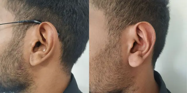 Pushback otoplasty | Lateral view | Davis and Mustarde procedures