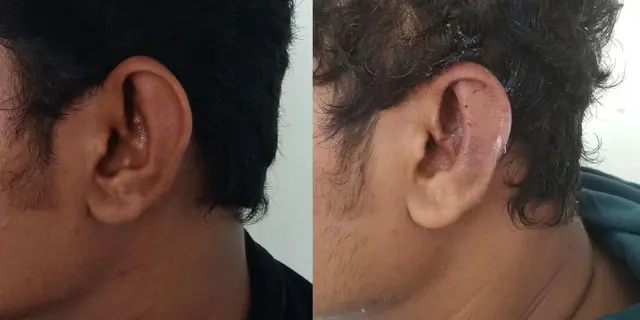 Pushback otoplasty | Lateral view | Davis and Mustarde procedures