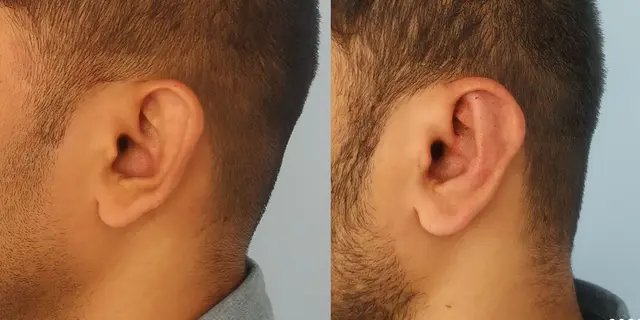 Pushback otoplasty | Lateral view | Davis and Mustarde procedures