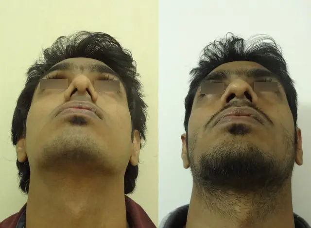 External valve reconstruction with auricular cartilage grafting.