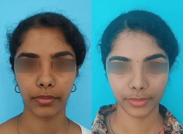 Tip-plasty with dorsal augmentation.