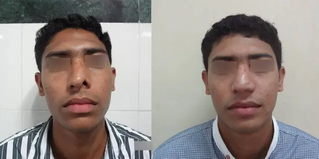 Congenital alar defect reconstructed with melolabial flap