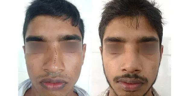 Crooked nose with saddle deformity