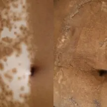 Vitiligo treated with split thickness skin graft | before and after